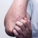 Fungal Skin Problem