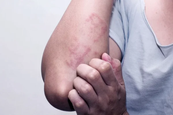 Fungal Skin Problem