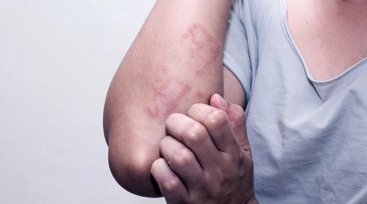 Fungal Skin Problem