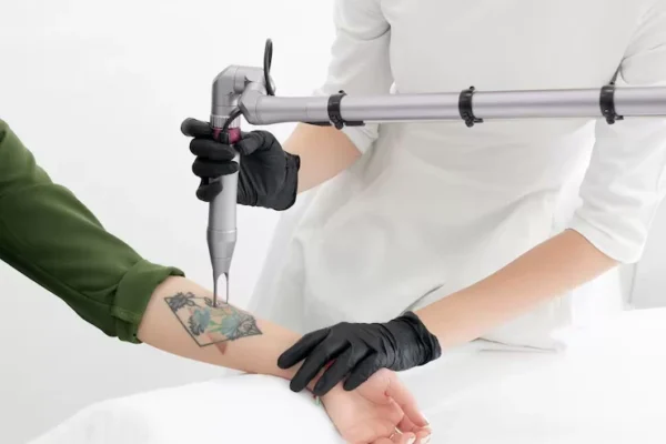 Laser Tattoo Removal