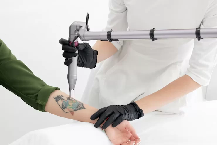 Laser Tattoo Removal